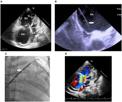 Sustained Hemodynamic and Clinical Improvements for a Patient With Idiopathic Pulmonary Arterial Hypertension Over 1.5 Years After Balloon Atrial Septostomy: A Case Report